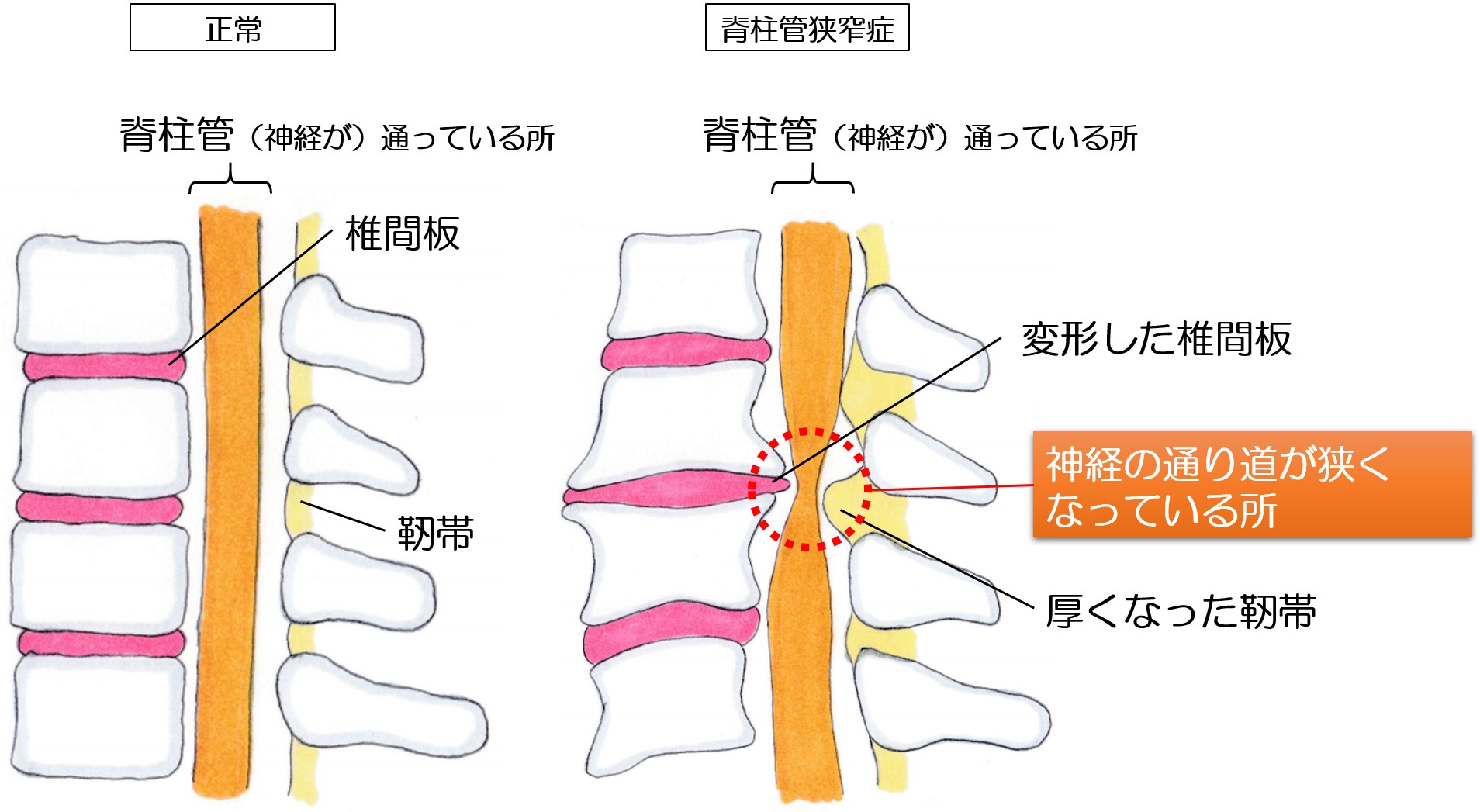 脊柱管狭窄症の画像